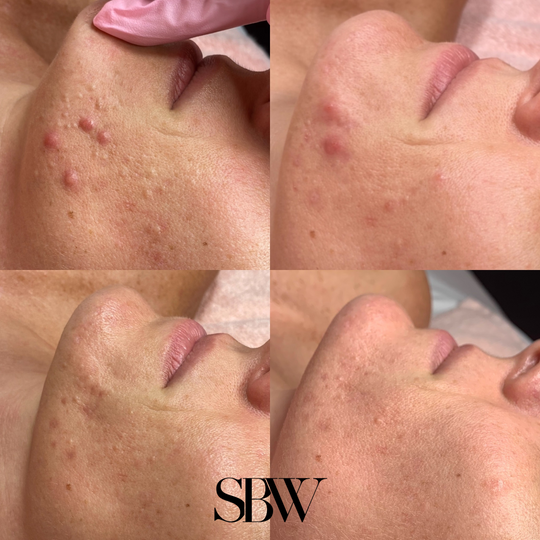 Treatment: JetPeel (Series of 4)