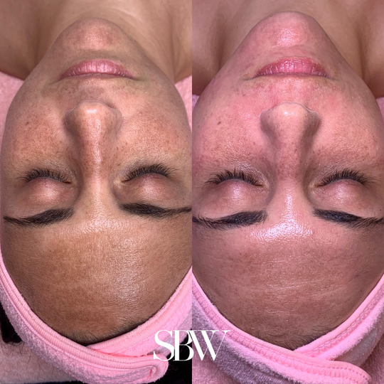 Treatment: Chemical Peel