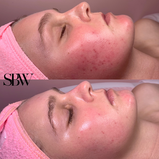 Treatment: JetPeel (two bi-weekly treatments)