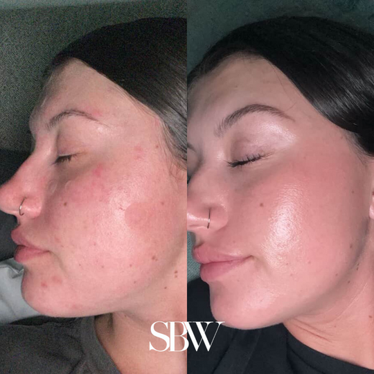 1 Week using SBW SKIN POREFECTING PEEL PADS