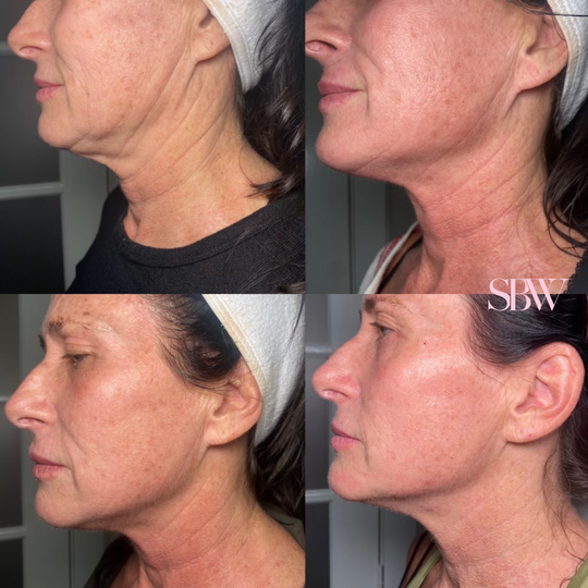 Treatment: 3 Sessions Morpheus8 Face + Neck