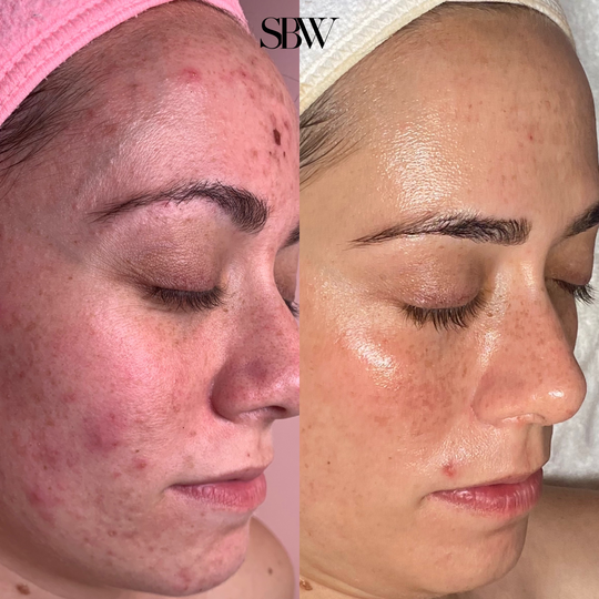 Treatment: Series of JetPeel, Custom Facials, & Chemical Peels (one Year)