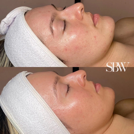 Treatment: Combination of SBW Custom Facials + Chemical Peels + Microneedling (6 mo. Progress)
