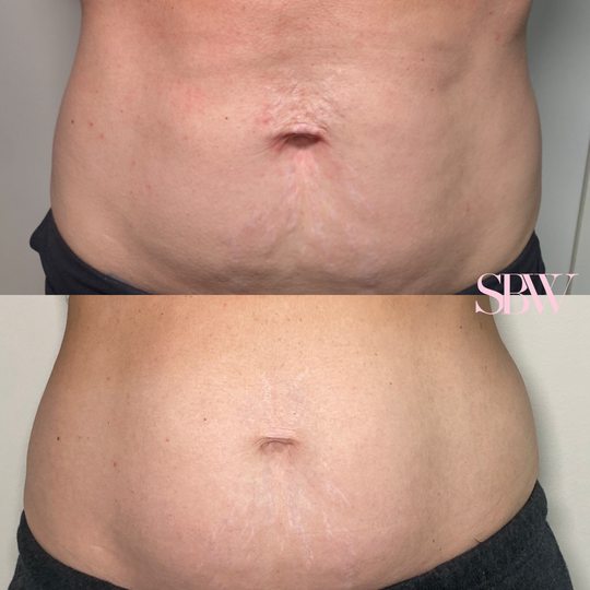 Treatment: 2 Sessions Morpheus8 Body Abdomen