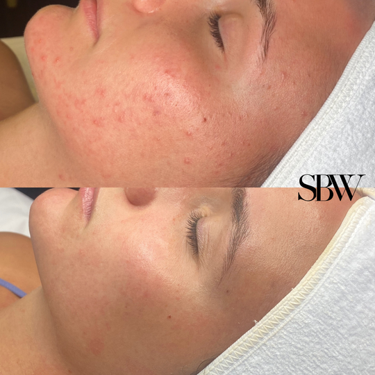 Treatment: Acne BootCamp + SBW Custom Facial