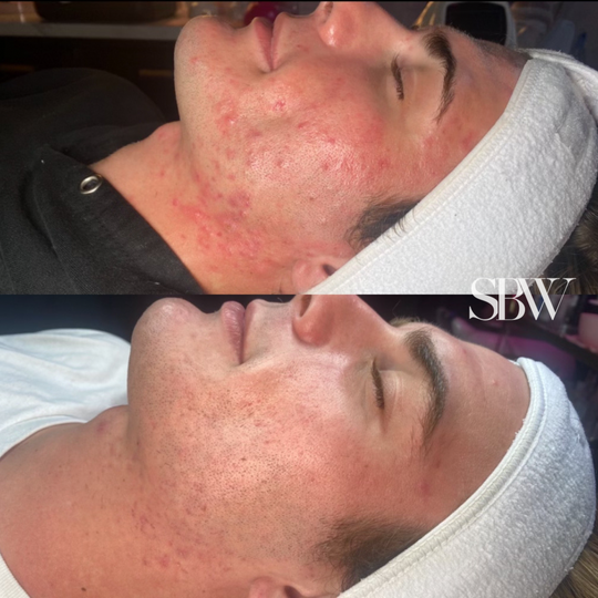 Treatment: Acne Boot Camp Series