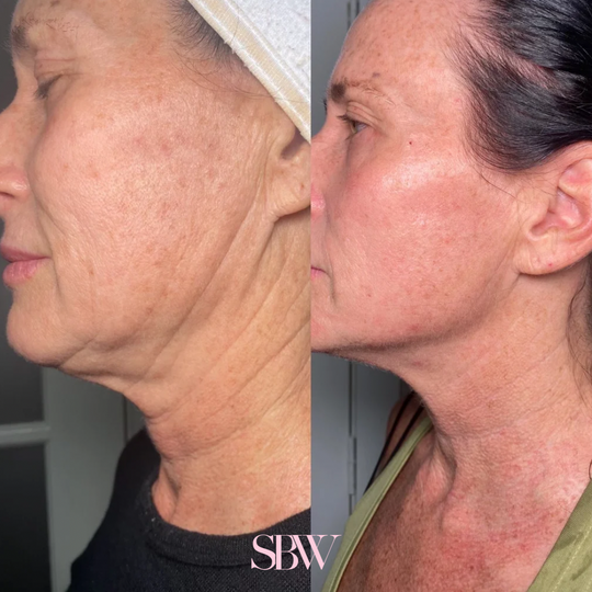 Treatment: 3 Sessions Morpheus8 Face + Neck