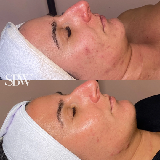 Treatment: Acne Boot Camp Series