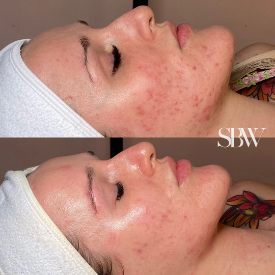 Treatment: 1 SkinPen Microneedling x BioRePeel + 1 SBW Deluxe Custom Facial