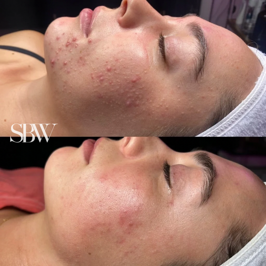Treatment: Acne Boot Camp Series